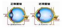 身患高度近视这种「绝症」，怎么买保险？