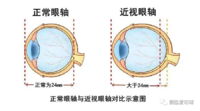 我在眼科医院，薅到的近视知识羊毛（三）